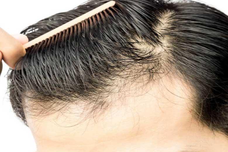 برای جلوگیری از ریزش مو چه کنیم؟